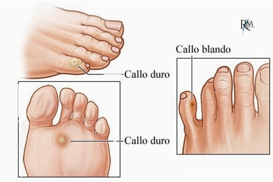 Tipos de callos plantares