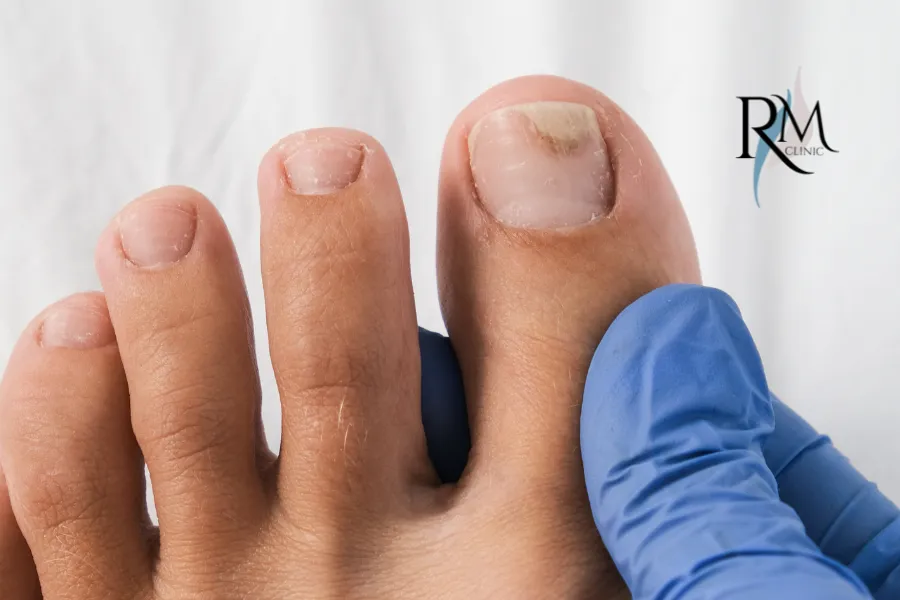hongos en las uñas de los pies
